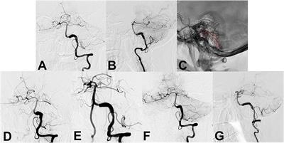 Stent-alone treatment of unruptured vertebral artery fusiform aneurysms: A comparison of flow diverter and conventional stents